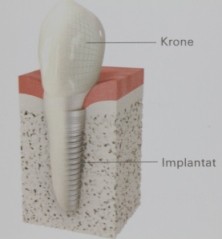 Krone auf Implantat 