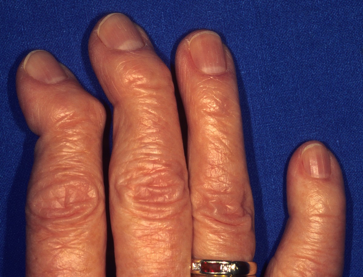 Arthrose Hand Finger Hannover Carls Heberden