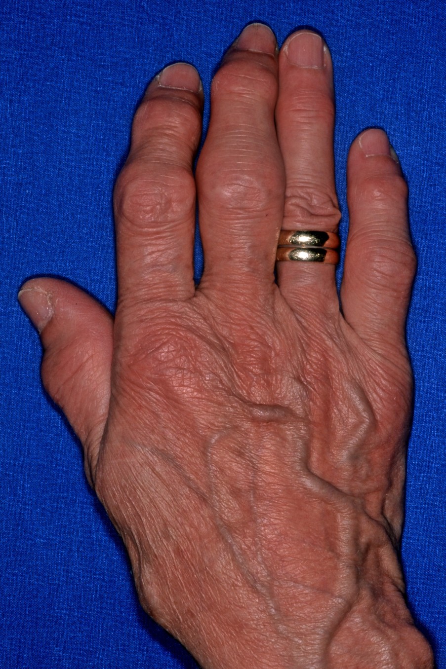 Arthrose Finger Hannover Carls Heberden Bouchard