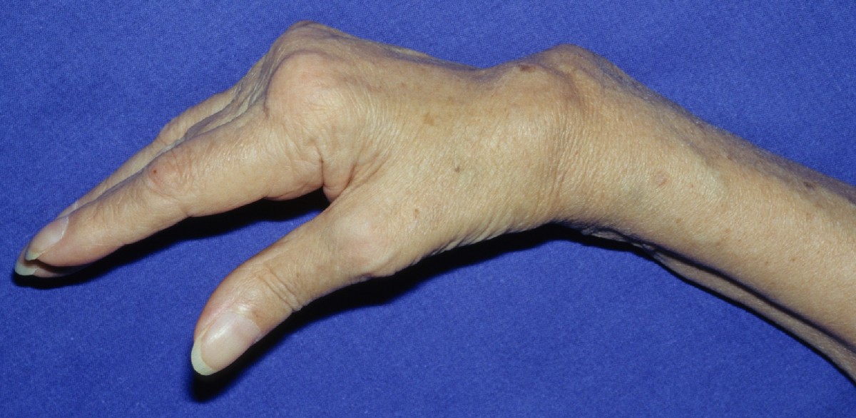 Bajonettfehlstellung bei rheumatoider Arthritis