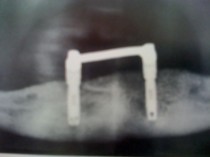 Dr. Zorn Implantate 