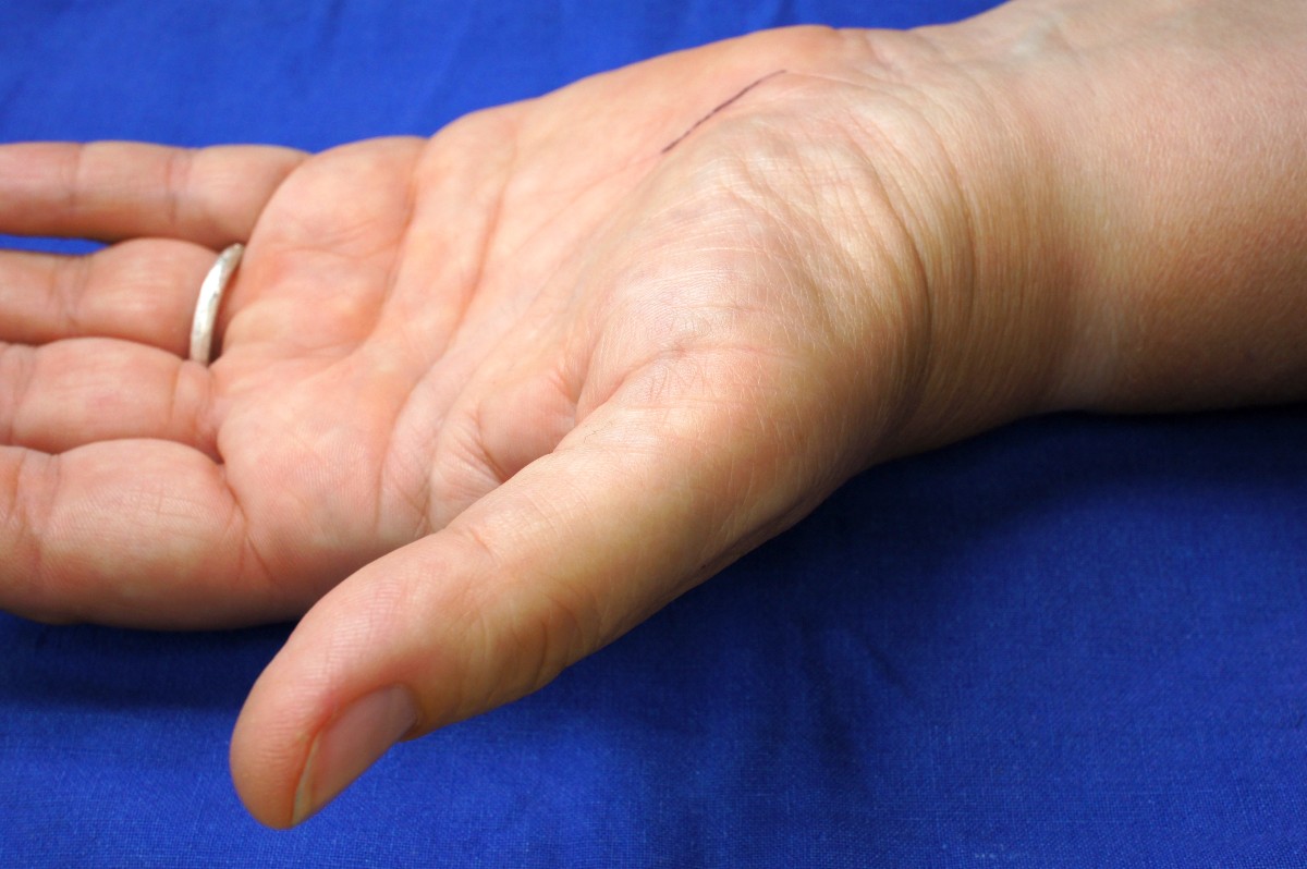 PD Dr. Carls Karpaltunnelsyndrom Hannover Marienstr. Spezialist OP ...