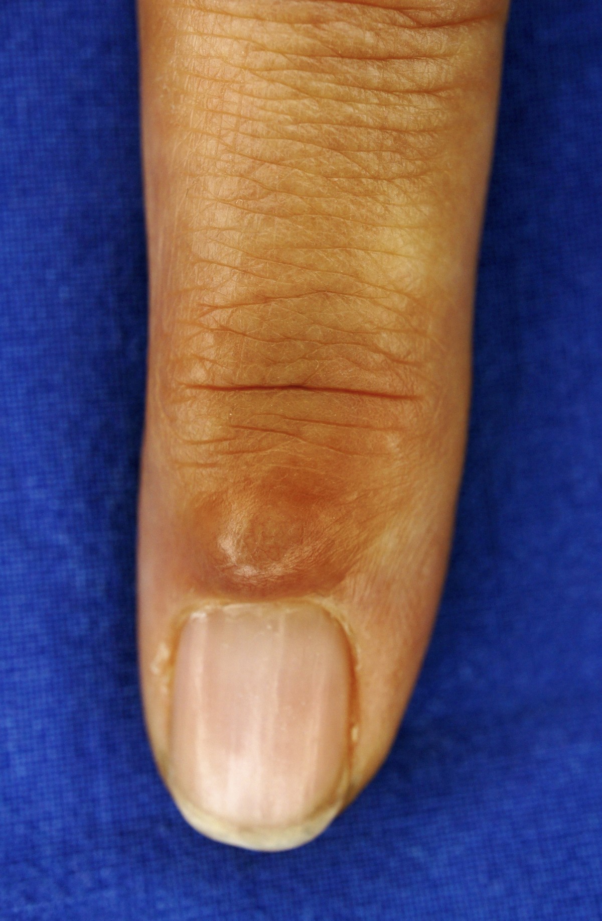Mukoidzyste Hannover Arthrose Finger Carls Hand