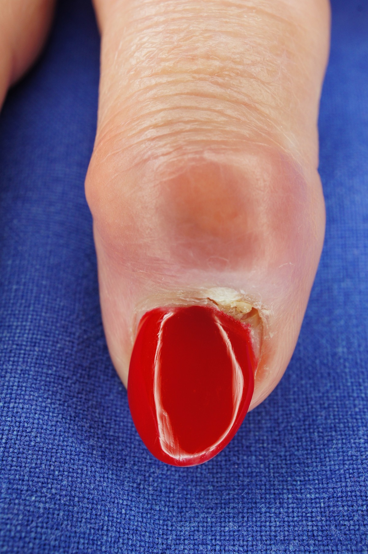 PD Dr. Carls Hannover Hand Finger Hannover Mukoidzyste Spezialist ...